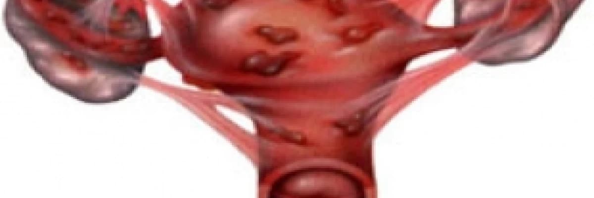 ÇİKOLATA KİSTİ ENDOMETRİOMA SİZİ KORKUTMASIN