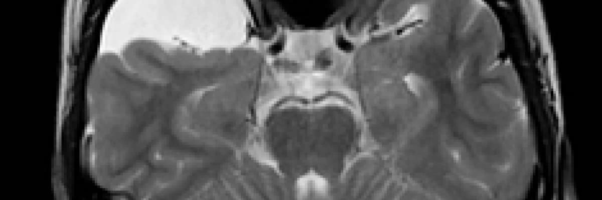 Araknoid Kist Hakkında