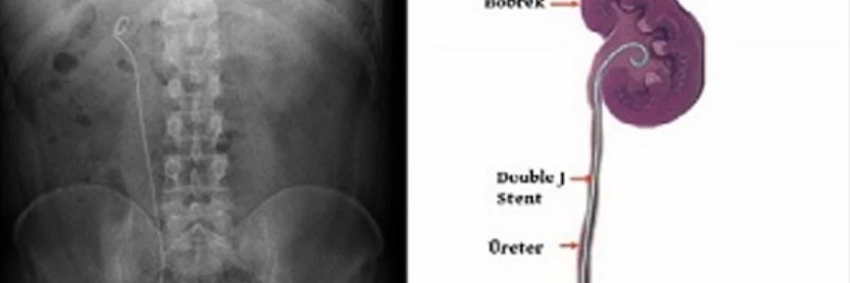 Böbreğe Takılan Çift J ( Double J) Stentler Hakkında Bilgi