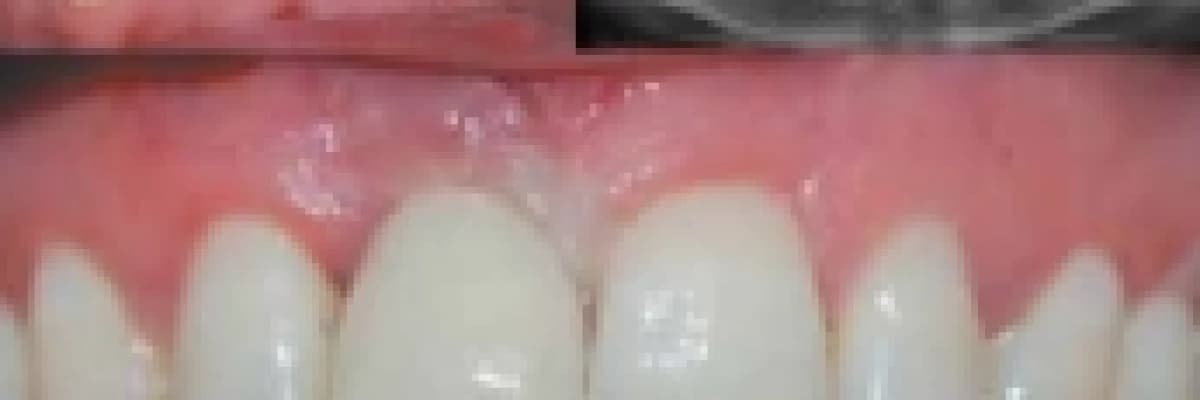 İmplant nedir, kullanımı hakkında ?