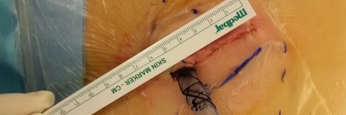 AKCİĞER VE YEMEK BORUSU HASTALIKLARINDA KAPALI AMELİYATLAR