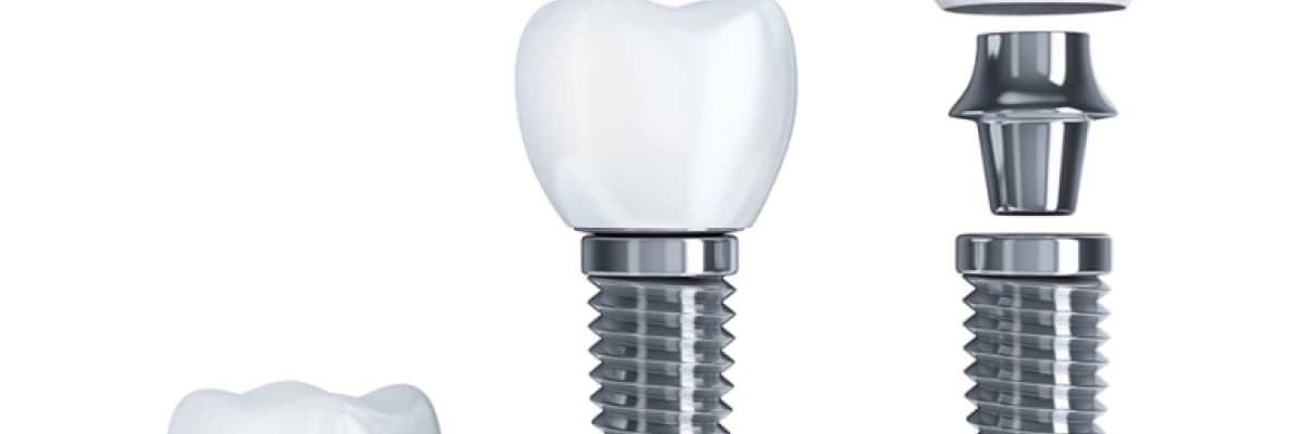 İmplant ve İleri İmplant Cerrahisi Uygulamaları