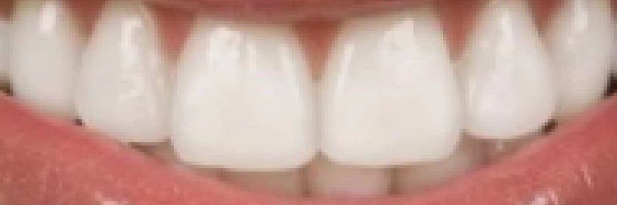 Porselen Diş, Porselen Köprü (Kuron, Köprü Protez)