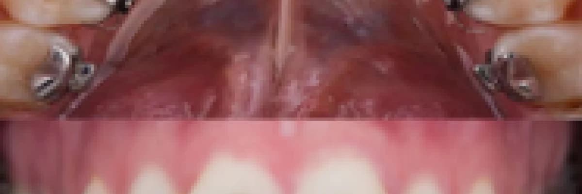 Ortodonti Tedavisi (Diş Teli)