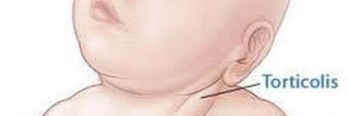 Boyunda eğrilik (tortikolis)