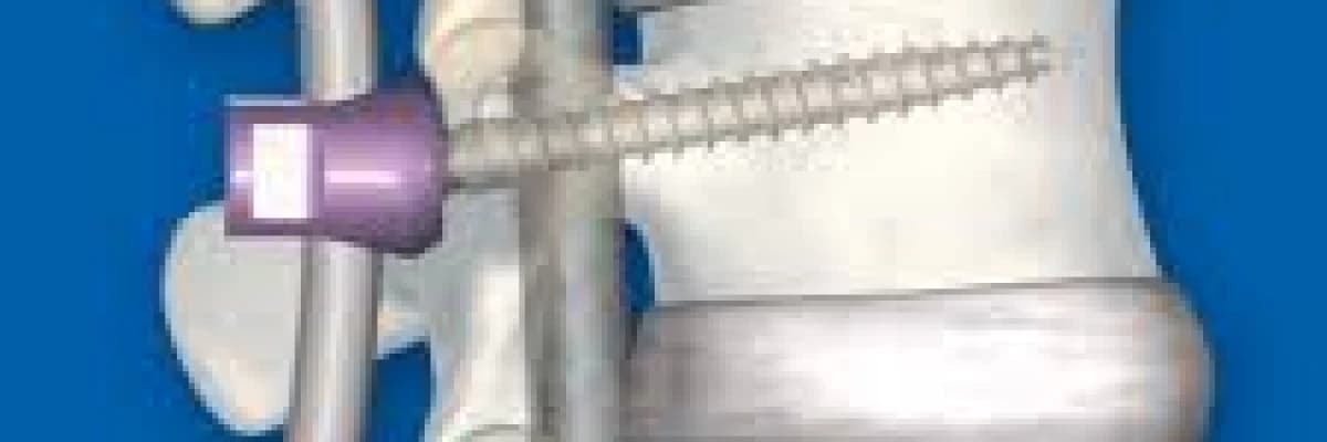 BEL VİDALAMA (PLATİNLEME) AMELİYATI