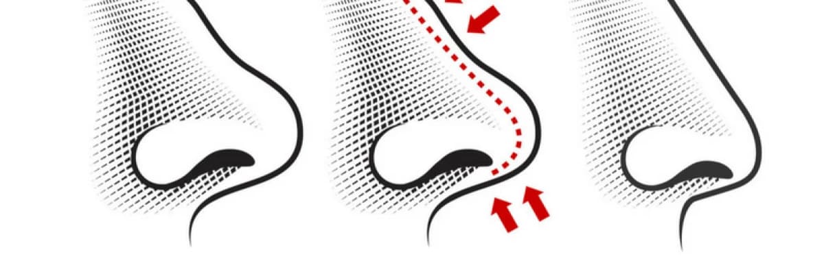 Ameliyattan Ne Kadar Zaman Sonra Burun Şekli Belli Olur?