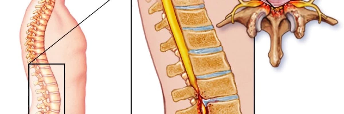 Mikrocerrahi teknikle omurga kanal daralması hastalığı tedavisi