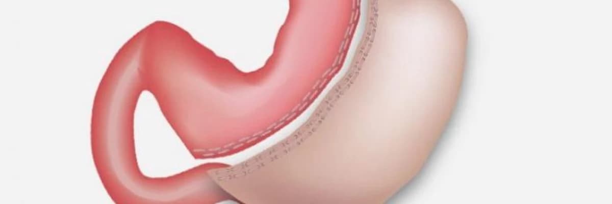 Obezite cerrahisinde tedavi seçenekleri