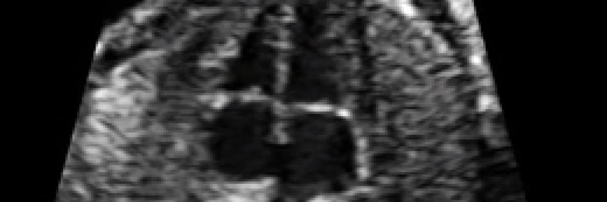 Bir muayene bulgusu olarak ÜFÜRÜM nedir?