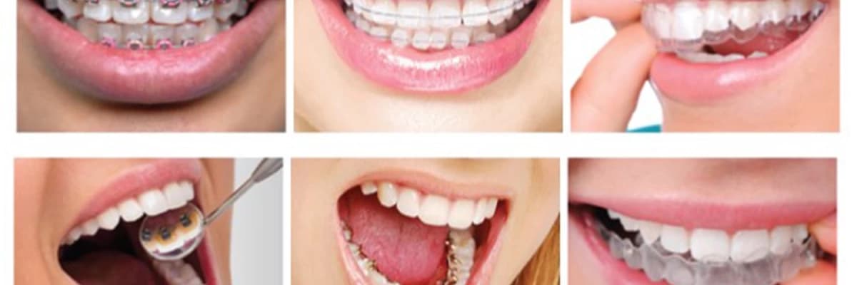 Yetişkinlerde ortodontik tedavi