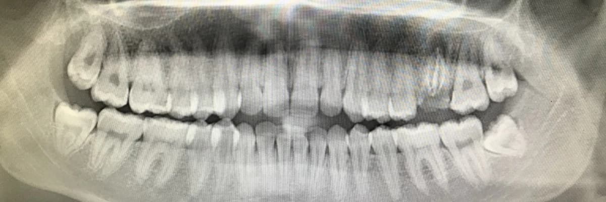 20 yaş dişi ne zaman çekilmelidir ?