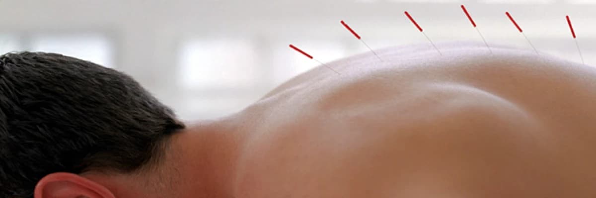 Akupunktur ile Bel ve Boyun Fıtığı tedavisi