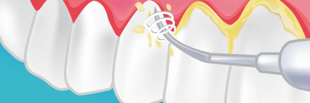 Diş Taşı Temizliği Nedir ?