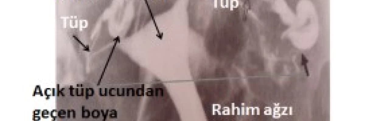 HSG (Histero-Salpingo-Grafi):