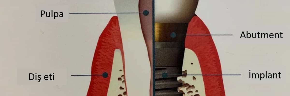 Eksik diş ve diişlerin yerine implant