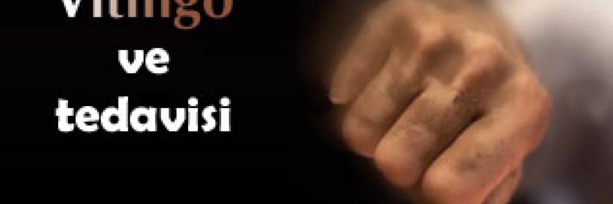 Vitiligo ve tedavisi