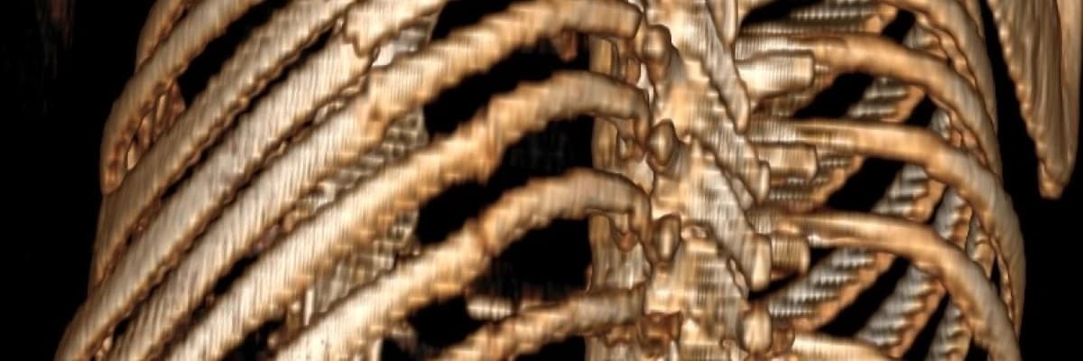 Kaburga Kırıkları