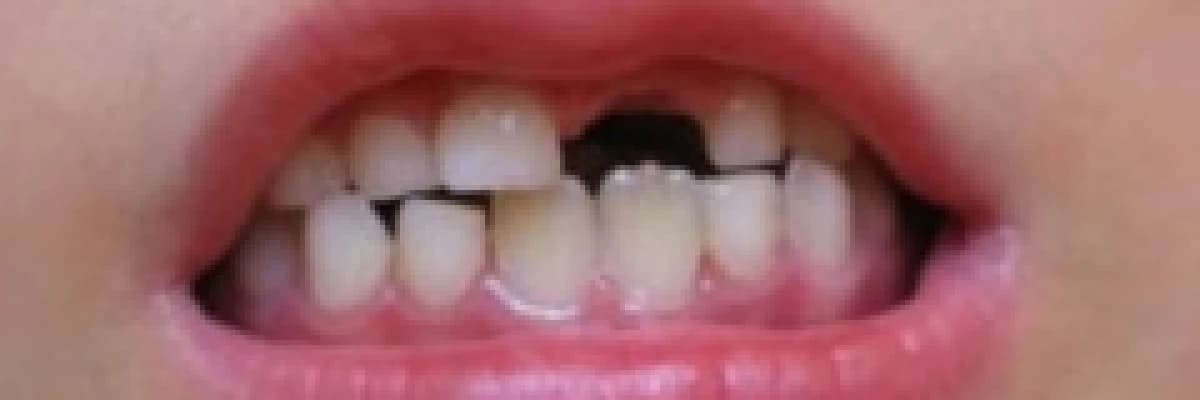 Süt dişleri neden önemlidir ?