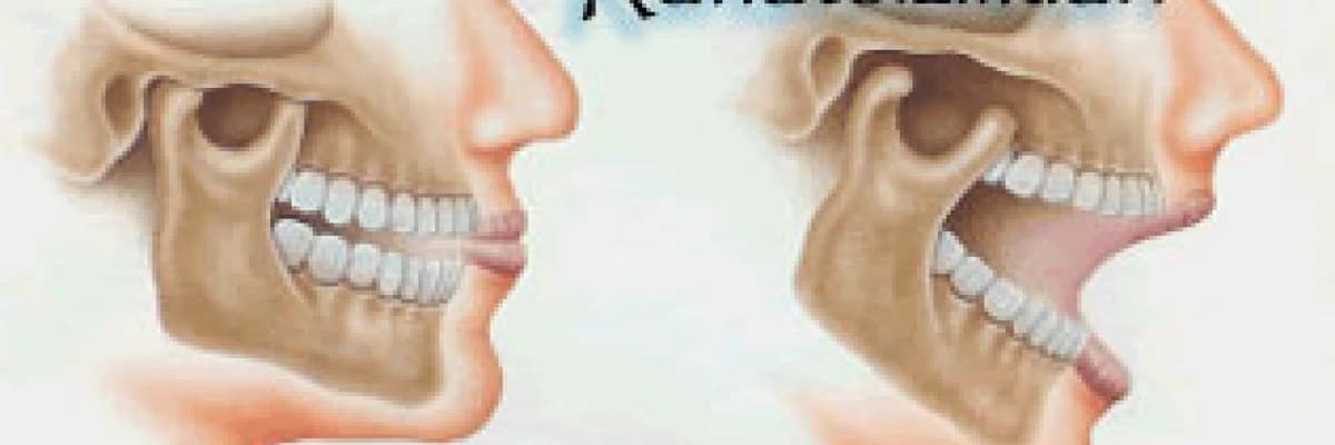 Çene Eklemi Rahatsızlıklarının Belirtileri