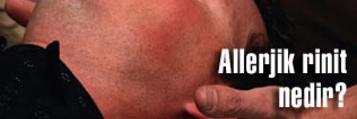 Allerjik rinit nedir? tedavisi nasıl olur?
