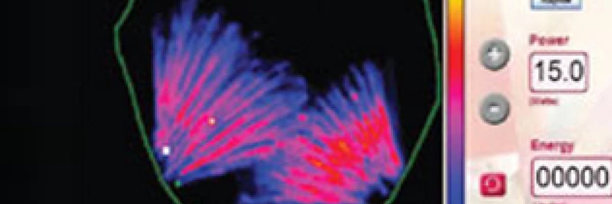 Navigasyonlu lazer lipoliz; lipocontrol