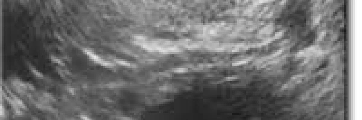 Yumurtlamanın artırılması (Kontrollü Over Stimülasyonu)