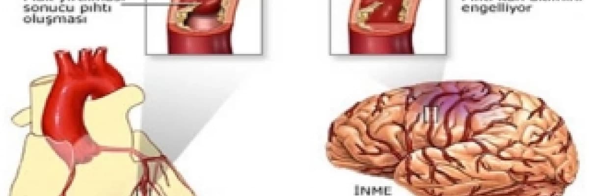 FELÇ (Stroke-İnme-Serebrovasküler olay)