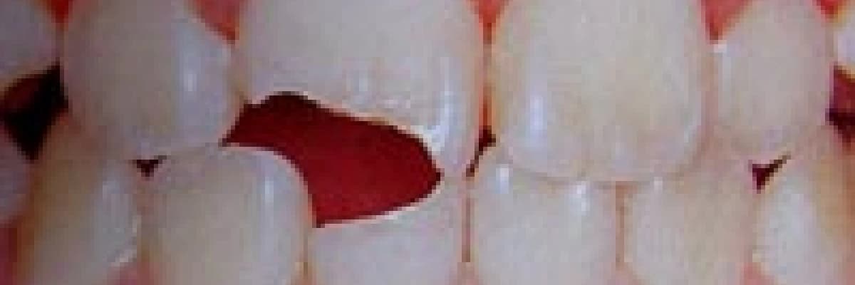 Çocukta diş kazaları. Diş Travmaları.