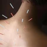 Akupunktur, akupunktur noktalarının özellikleri