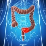 KALIN BARSAK KANAMALARI