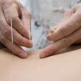 AKUPUNKTUR; MUTLU, HUZURLU, SAĞLIKLI BİR YAŞAM İÇİN.