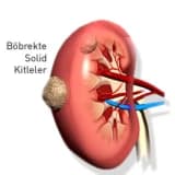 Böbrek Tümörleri ve Tedavisi
