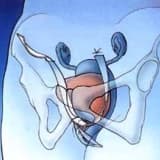 kadınlarda idrar kaçırma ve tedavi seçenekleri