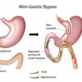 Mini Gastric Bypass Ameliyatı