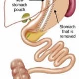 Tüp Mide Ameliyatı nasıl etki eder?