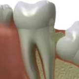 Gömülü Dişler ve 20 Yaş Dişler