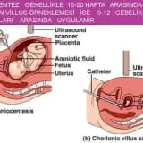 Amniyosentez nedir? Gebeliğin kaçıncı haftası yapılır?