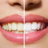 DİŞ BEYAZLATMA İLE İLGİLİ SIKÇA SORULAN SORULAR