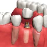 İMPLANTOLOJİ ve ÇENE İMPLANTLARI hakkında sık sorulan sorular