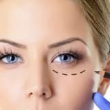 Göz Çevresi Estetiği (Bleferoplasti)