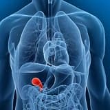 Safra Kesesi Taşı, teşhis, tedavi ve laparoskopik ameliyat