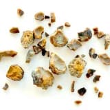 Böbrek taşı hakkında doğru bilinen yanlışlar