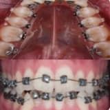 Ortodonti Tedavisi (Diş Teli)