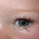 Bebeklerde göz sulanması, doğumsal göz yaşı kanal tıkanıklığı