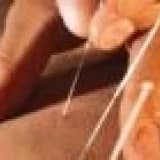 Akupunktur ve tarihcesi