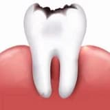 Çürük Nedir ? Tedavisi Nasıl Yapılır ?