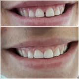 Diastema