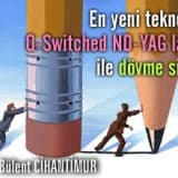 En yeni teknoloji q-switched nd-yag lazer ile dövme silme