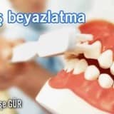 Diş beyazlatma!
